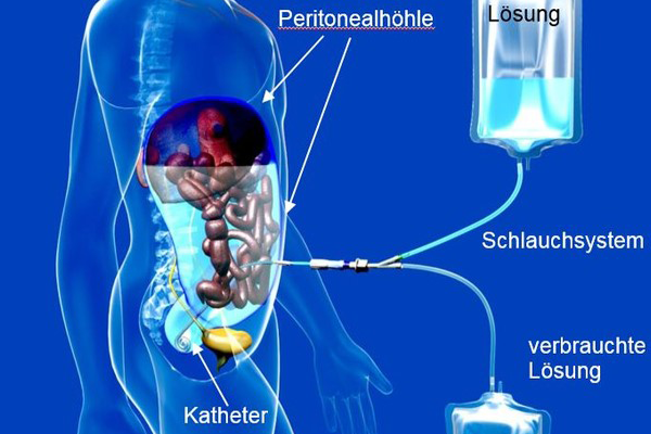 DE-Renal-PD-Therapien